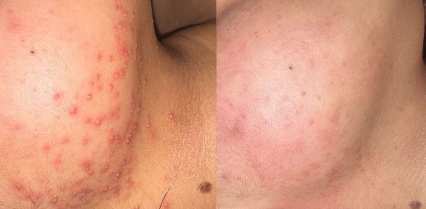 Antes e depois de acne na região da mandíbula e pescoço