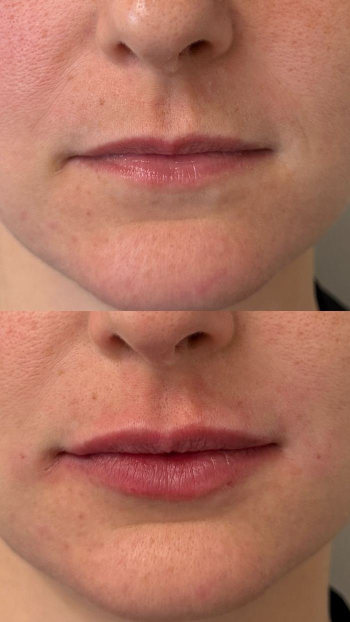 Antes e depois de preenchimento labial