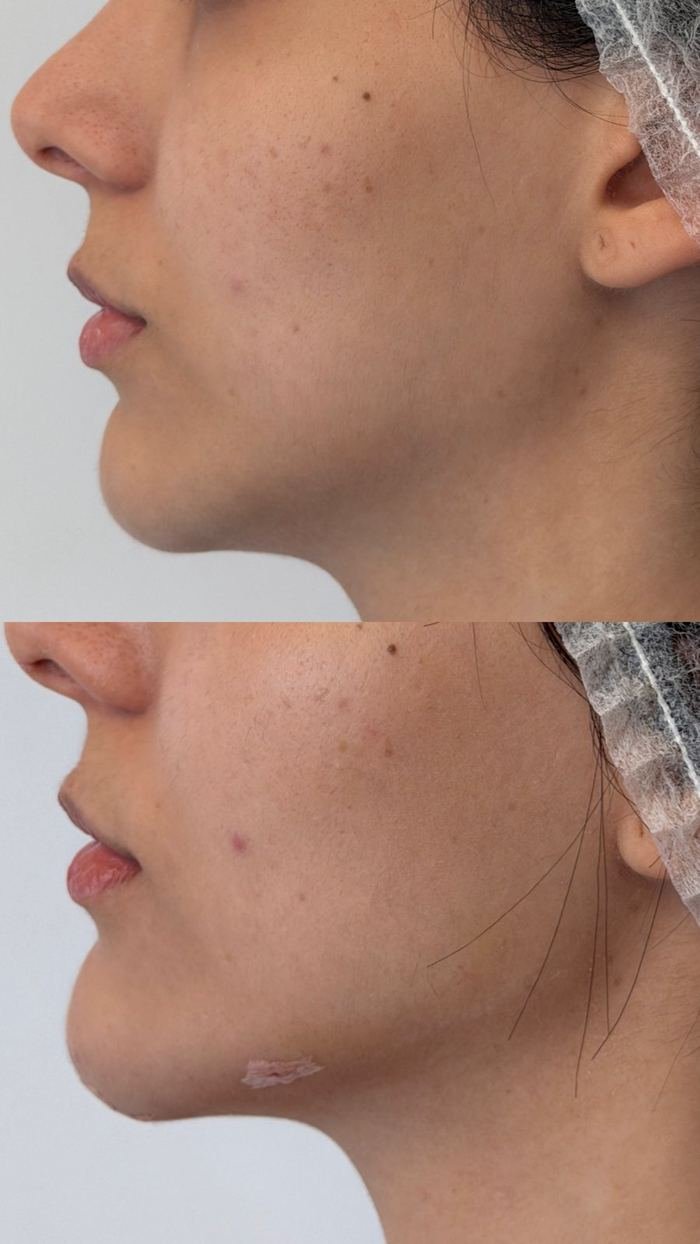 Antes e depois de preenchimento de mento e mandíbula, vista de perfil
