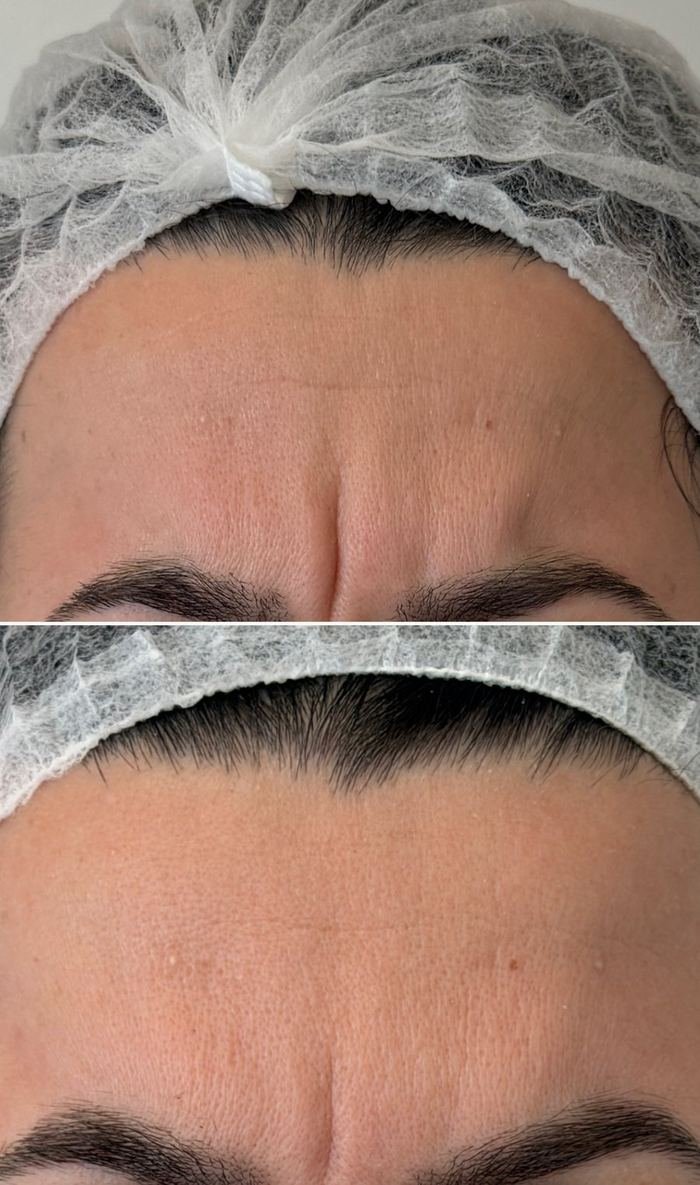 Antes e depois de toxina botulínica na testa e glabela