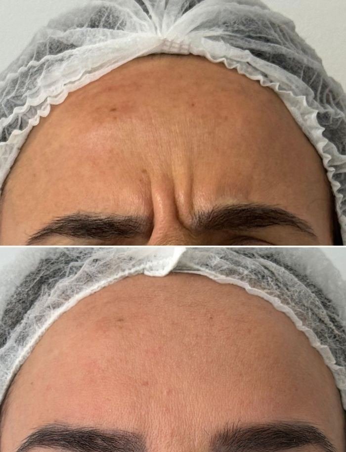 Antes e depois de toxina botulínica na glabela
